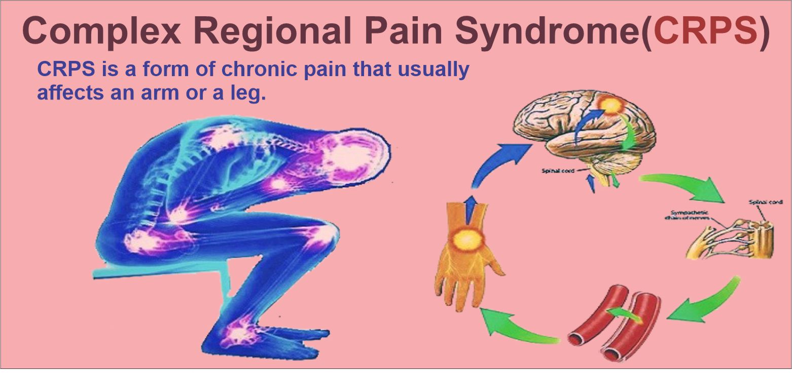 HBOT For Complex Regional Pain Syndrome (CRPS)/ (RSD)